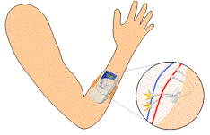 STIMuGRIP ® system